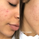 One of Glossier’s campaign photos for the launch of its acne treatment, Solution.